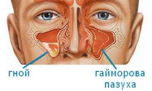 Симптомы рака полости носа