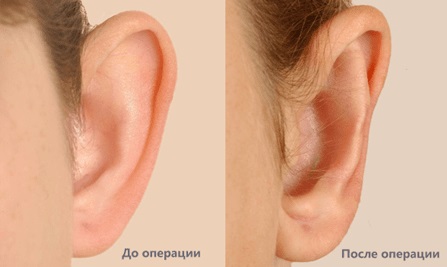 Пластика вух в Одесі